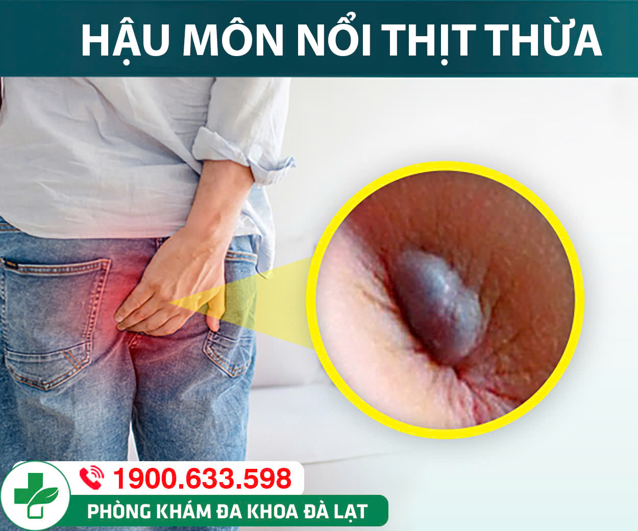 Nổi mụn ở hậu môn là dấu hiệu của bệnh lý nguy hiểm nào?